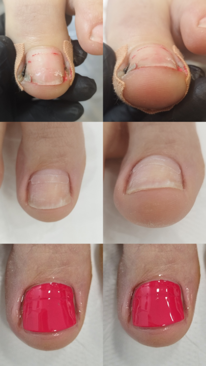 Riješite se uraslih noktiju uz medicinsku pedikuru!