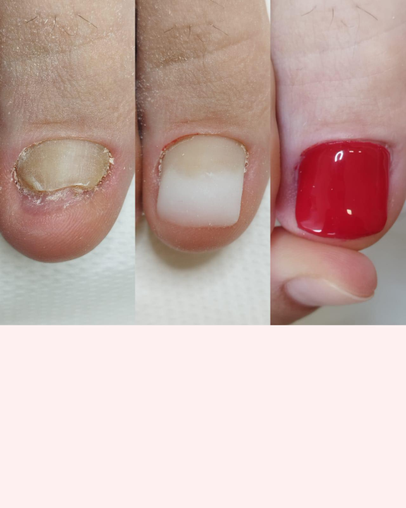 Pružite svojim stopalima maksimalnu njegu i riješite tegobe uz medicinsku pedikuru!