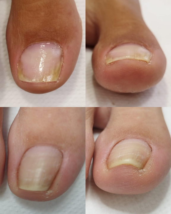 Pružite svojim stopalima maksimalnu njegu i riješite tegobe uz medicinsku pedikuru!