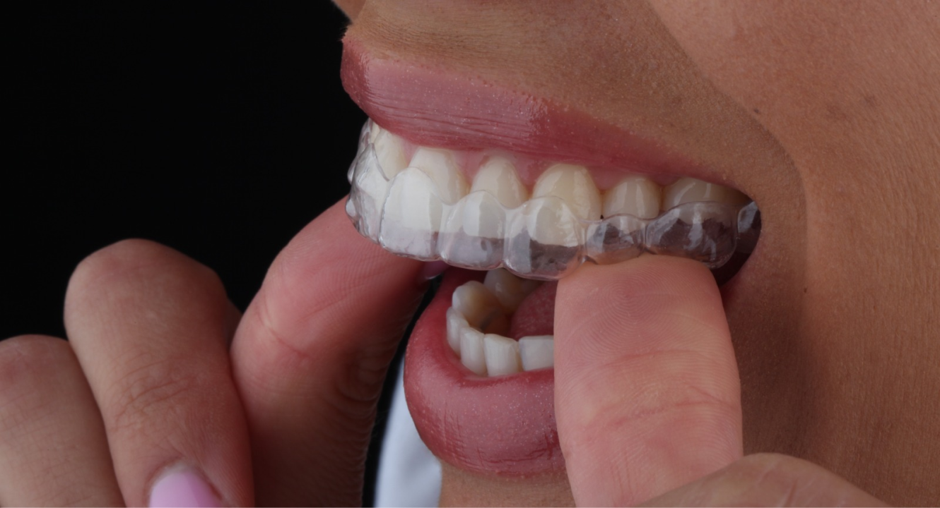 FOTO Saznajte sve o prozirnim aparatićima na Danima otvorenih vrata Dental centra Dubravica!