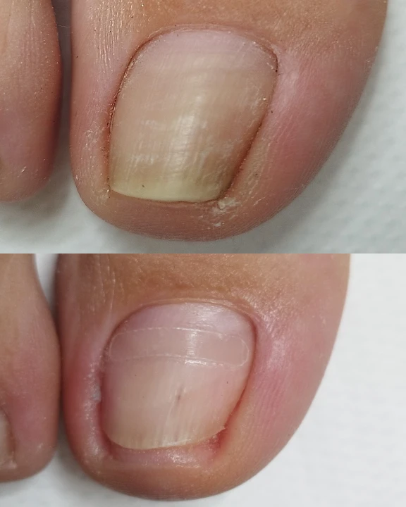 Riješite se uraslih noktiju uz medicinsku pedikuru!