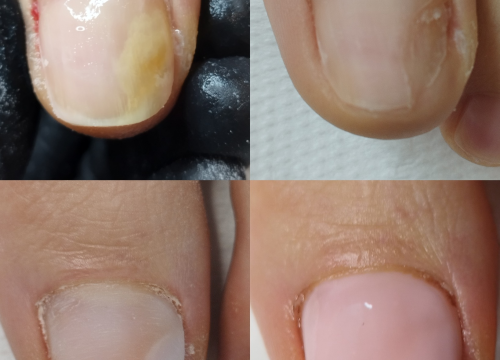 Fotografija 6 - Riješite se uraslih noktiju uz medicinsku pedikuru!