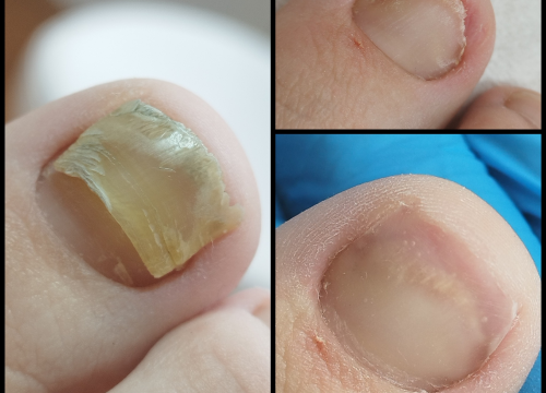 Fotografija 10 - Riješite se uraslih noktiju uz medicinsku pedikuru!