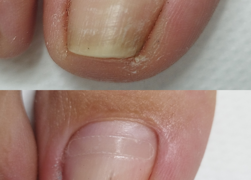 Fotografija 18 - Riješite se uraslih noktiju uz medicinsku pedikuru!