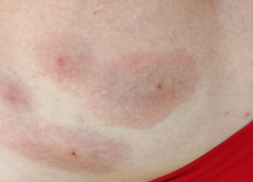 Kakve su to pješčane muhe koje su navodno izgrizle Slovence na Murteru?