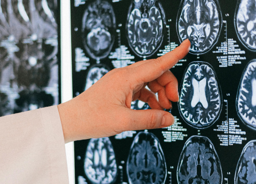 Porast oboljelih: Evo kako prepoznati multiplu sklerozu i tko je ugroženiji