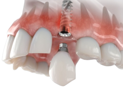 Fotografija 7 - FOTO Životna prekretnica uz Dental centar Dubravica: Što trebate znati prije ugradnje implantata