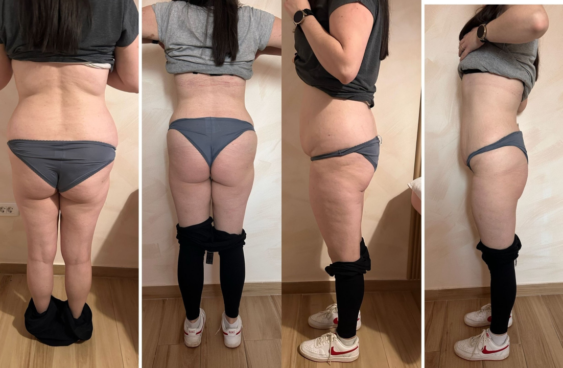 FOTO Skinite do 10 kilograma u 6 tjedana uz Beauty Clinic by Tamara