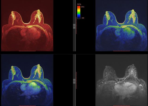 Fotografija 2 - Pupillam poliklinika: Na vrijeme otkriven karcinom dojke praktički izlječiva bolest u 98 posto slučajeva